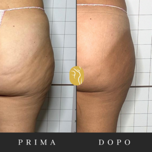 Prima e dopo: cellulite e culotte de cheval