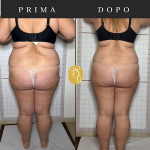 Prima e dopo: riduzione e rimodellamento del corpo