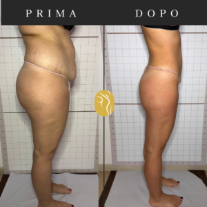Prima e dopo: riduzione e rimodellamento del corpo
