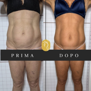 Prima e dopo: miglioramento dell’atonìa tissutale
