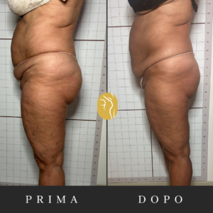 Prima e dopo: miglioramento della circolazione e della buccia d’arancia
