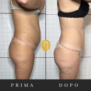 Prima e dopo: riduzione del gonfiore addominale